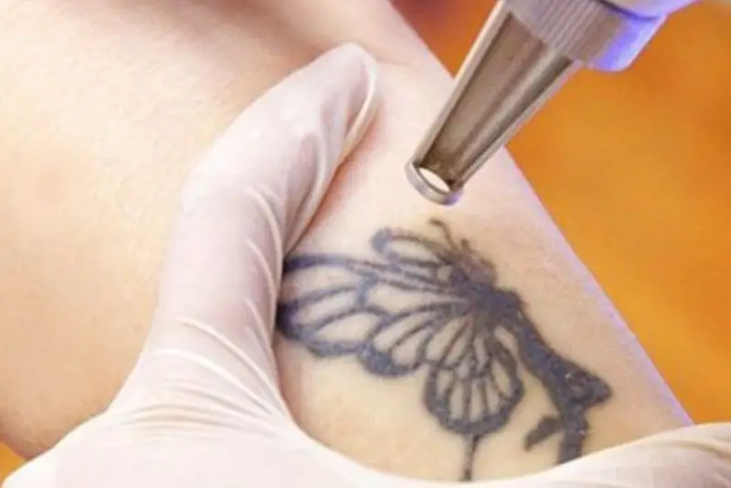 Không thể xóa hình xăm chỉ sau 1 lần