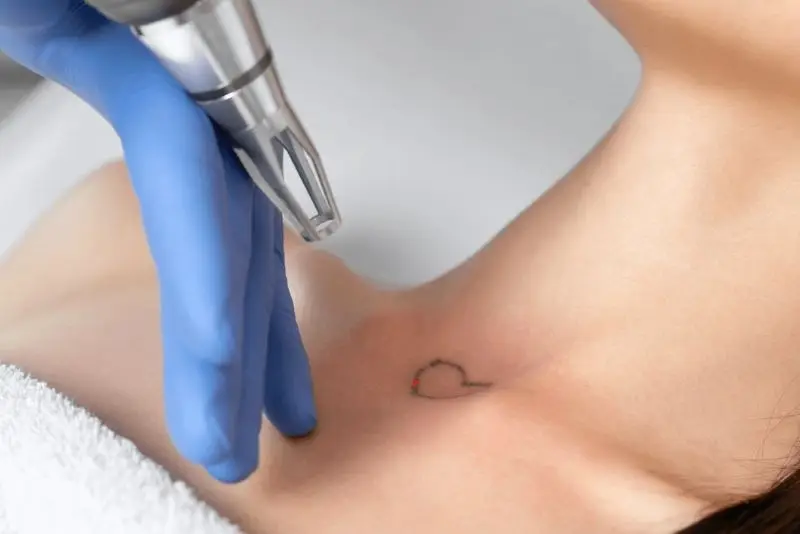 Các loại laser xóa xăm thế hệ mới như Laser PicoSure, Picosure Pro hay Laser Q-Switched hoạt động dựa trên cơ chế tác động chọn lọc vào các phân tử mực xăm