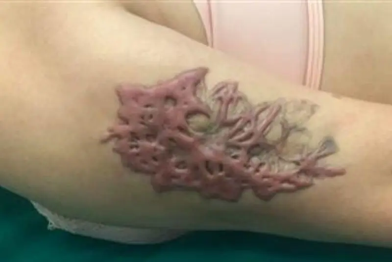 Chăm sóc sau xóa không đúng gây nhiễm trùng, dễ dẫn đến sẹo