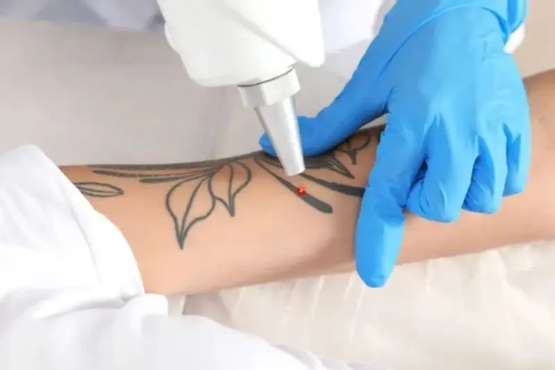 Xóa xăm bằng laser