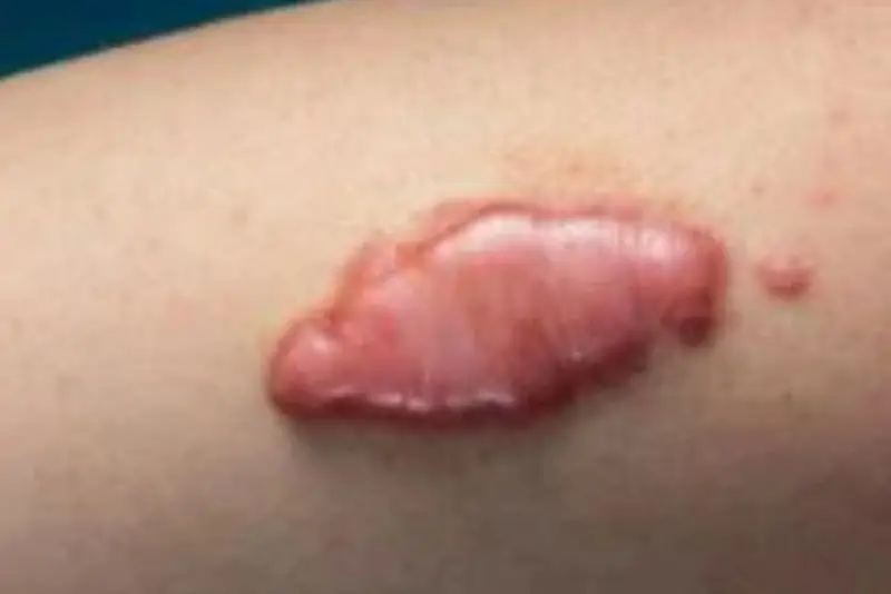 Có tiền sử sẹo lồi cần thông báo với bác sĩ trước khi xóa xăm