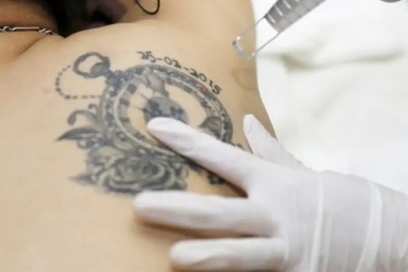 Xóa hình xăm có thời gian từ 10 - 30 phút