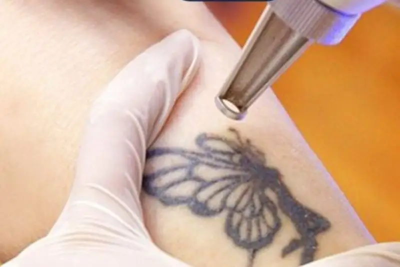 Xóa hình xăm ở đùi cần khoảng 15 - 30 phút