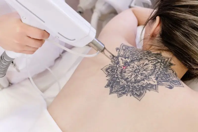 Xóa hình xăm bằng laser không đau vì đã được ủ tê