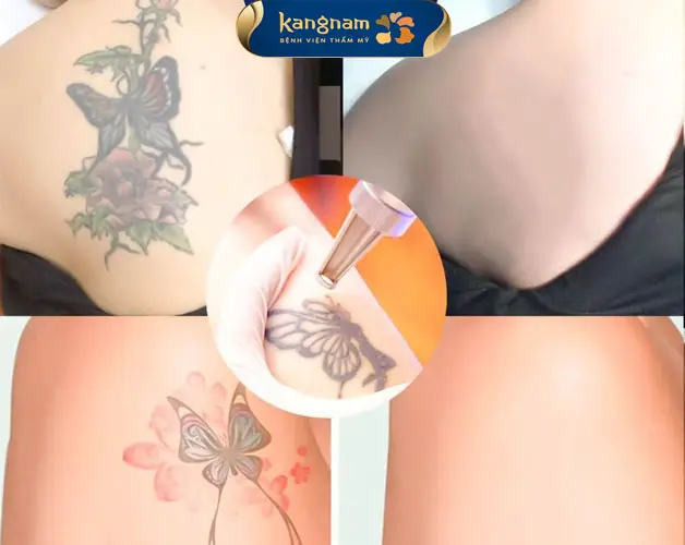 Xóa sạch hình xăm màu