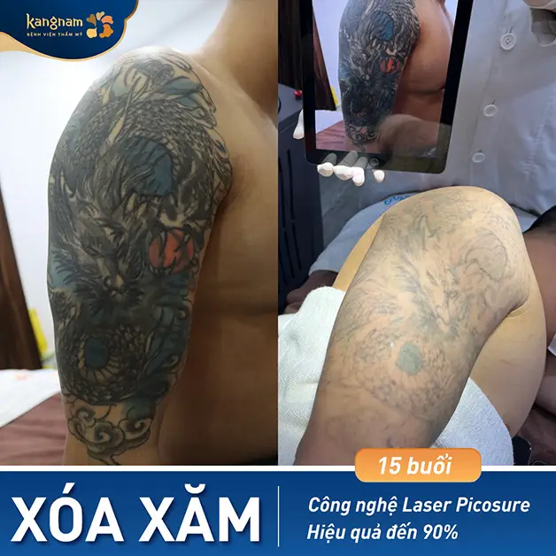Khách hàng xóa xăm tại Kangnam