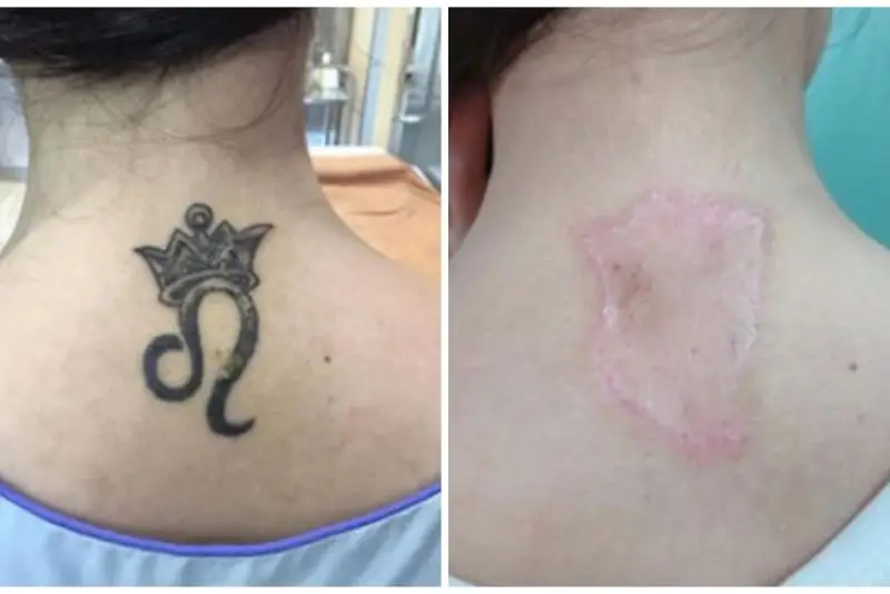 Da hơi ửng đỏ, đang trong giai đoạn hồi phục