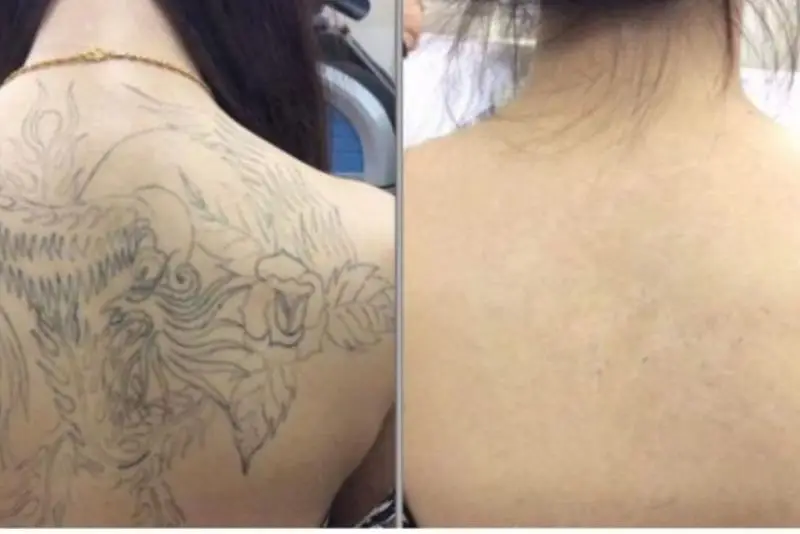 Cách chăm sóc sau khi xóa xăm