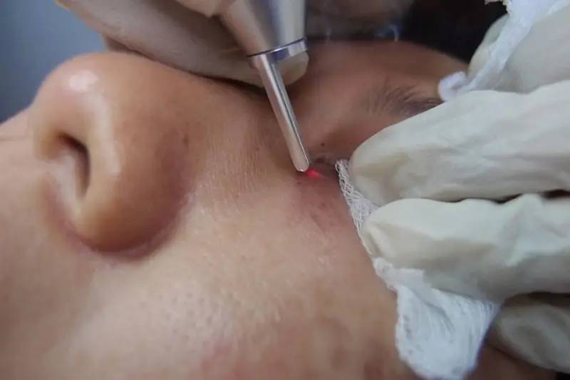 Laser là phương pháp trị mụn thịt được bác sĩ áp dụng