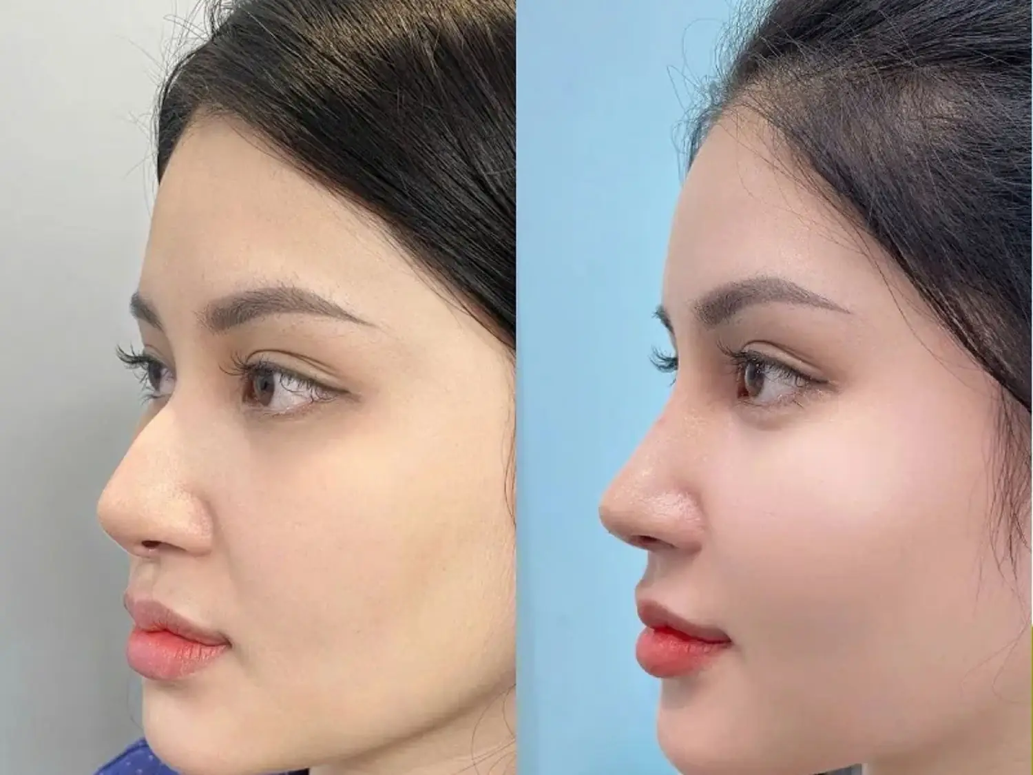 Hương Ly là khách hàng từng nâng mũi trước đó nhưng gặp biến chứng nặng, ảnh hưởng và sau khi chỉnh sửa mũi tại Kangnam, mũi cao, thẳng và cân đối