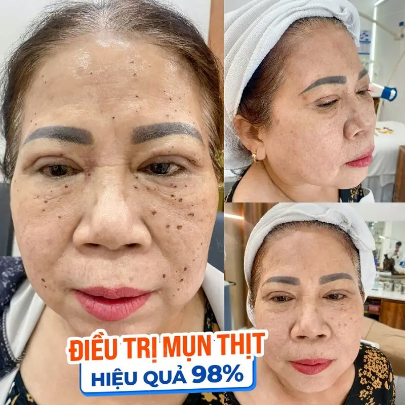 Hiệu quả trị mụn thịt lên đến 98%