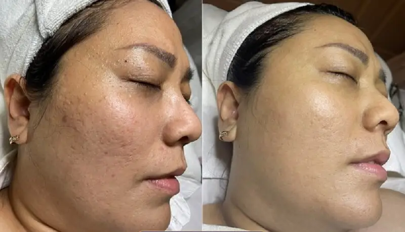 Giữ da sạch sẽ, khô ráo sau khi trị mụn