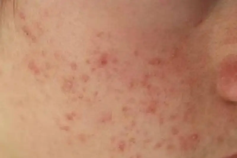 Lăn trứng gà không thể hết thâm mụn hoàn toàn