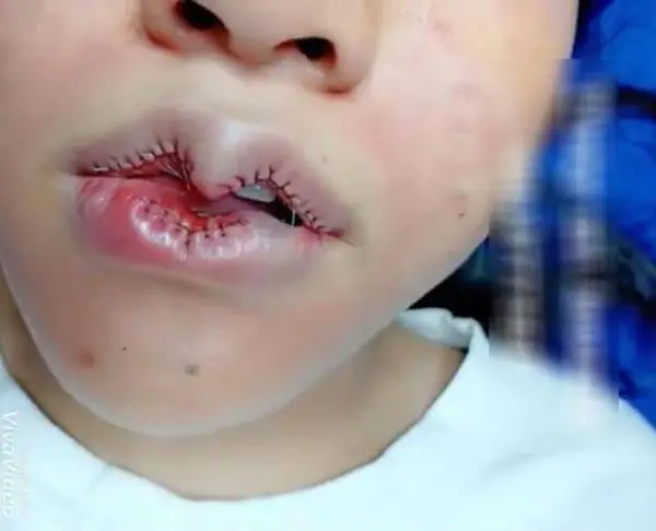 Khó cử động môi sau phẫu thuật