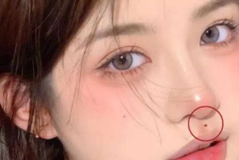 Nhân trung có sẹo hoặc nốt ruồi phản ánh những thăng trầm