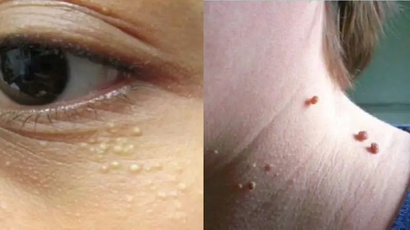 Mụn thịt cần điều trị để không lây lan ra các vùng xung quanh