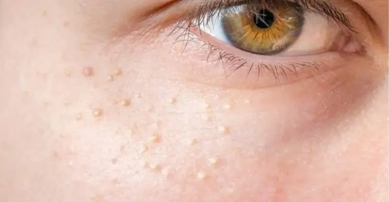 Mụn thịt ẩn dưới da mọc ở nhiều vị trí trên mặt, cổ