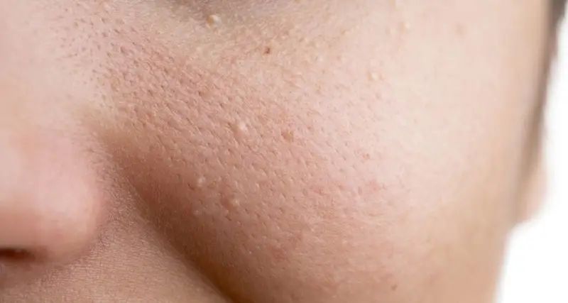 Những nốt mụn thịt sần sủi, li ti trên bề mặt da