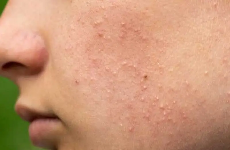 Tự ý nặn mụn ẩn có thể gây nhiễm trùng