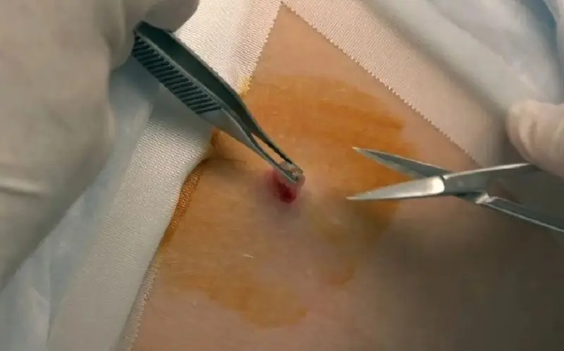 Đến cơ sở chuyên khoa để được tư vấn phương pháp loại bỏ hiệu quả