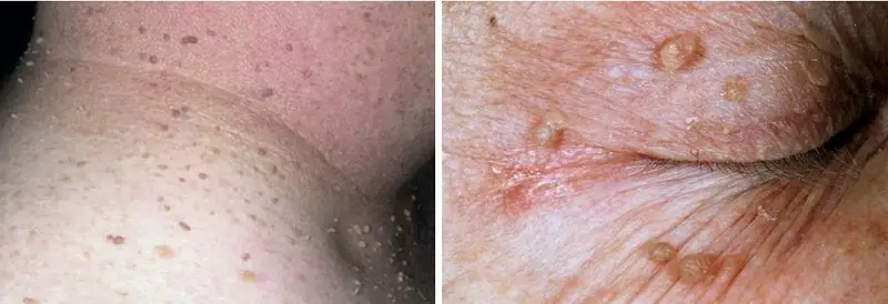 Nặn mụn thịt không đúng cách sẽ gây viêm nhiễm hoặc lan rộng các nốt mụn