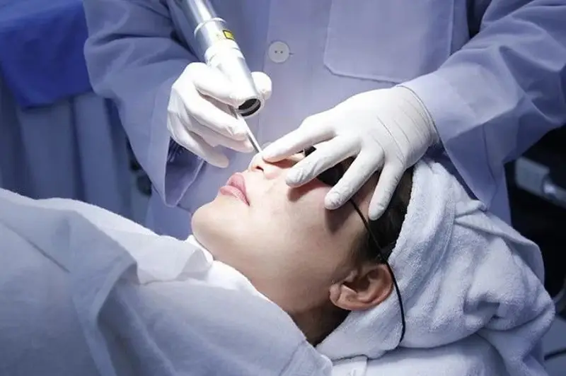 Laser là phương pháp trị mụn thịt được nhiều bác sĩ áp dụng