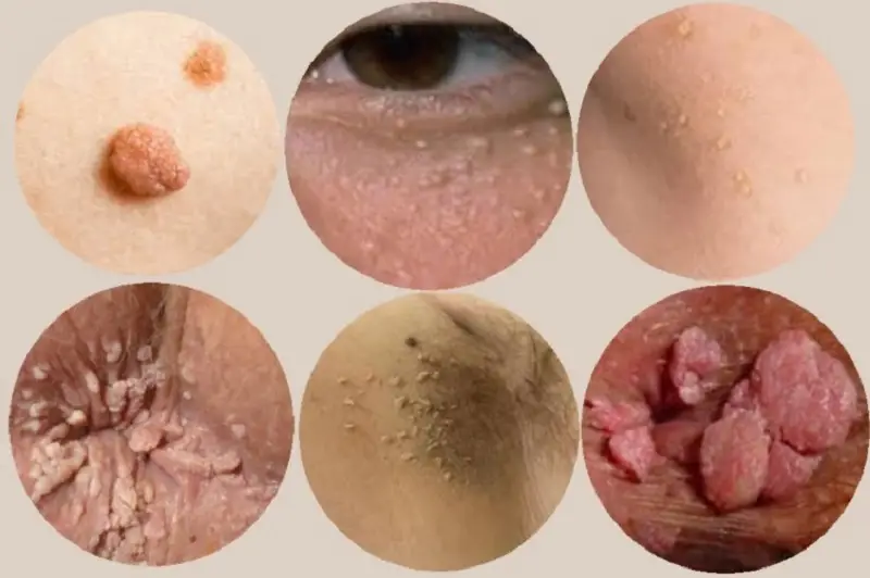 Mụn thịt do thay đổi nội tiết hoặc thói quen sinh hoạt gây nên