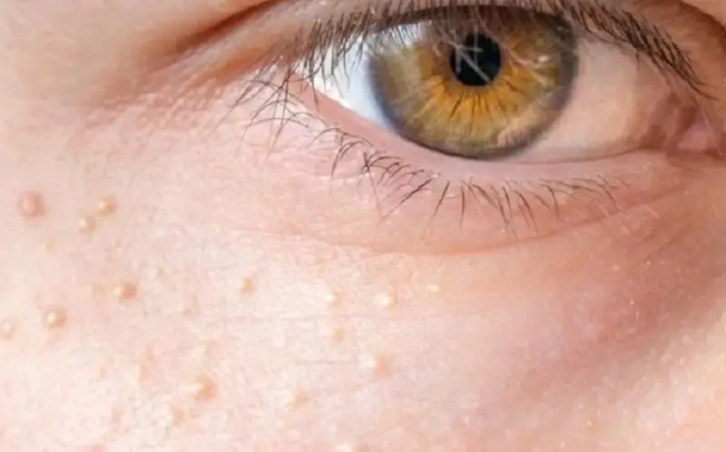 Mụn thịt là do đâu - Do Rối loạn collagen dẫn đến sự phát triển của nốt mụn