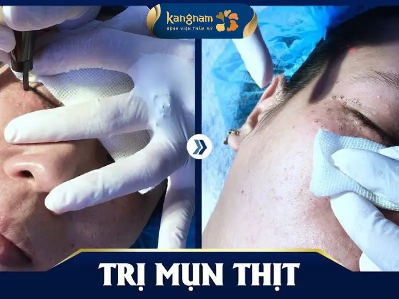 Công nghệ trị mụn hiện đại giúp loại bỏ nốt mụn thịt nhanh