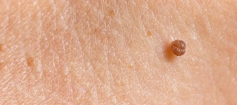 Mụn thịt dư có thể không nguy hiểm nhưng sẽ lây lan sang các vùng da xung quanh