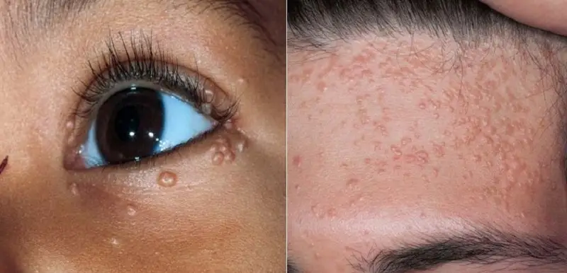 Mụn thịt dư không điều trị có thể ảnh hưởng đến tính thẩm mỹ