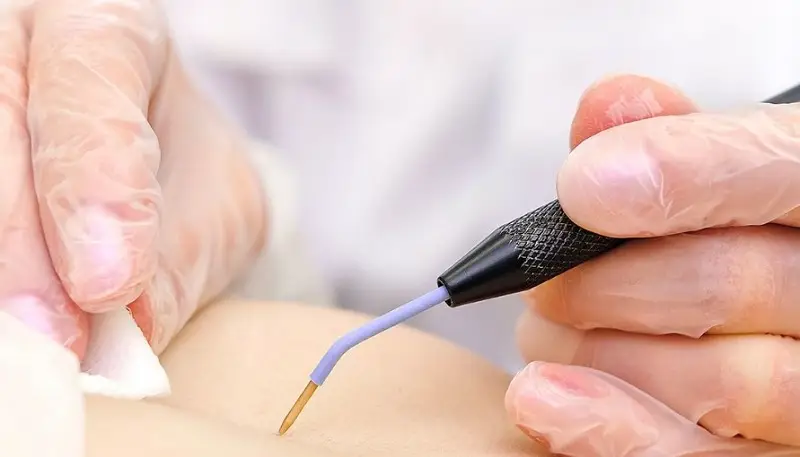 Đốt mụn thịt được nhiều người lựa chọn