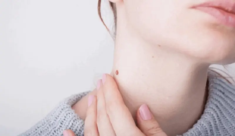 Chăm sóc và vệ sinh các nốt mụn đúng cách, không được nặn mụn thịt