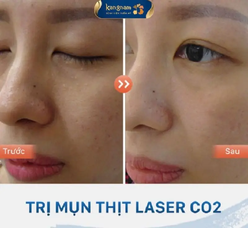 Phương pháp Laser Co2 được các bác sĩ sử dụng để trị các nốt mụn thịt