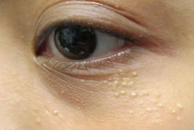 Mụn thịt hình thành do yếu tố di truyền, thay đổi nội tiết