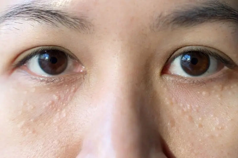 Mụn thịt li ti trên mặt chỉ là những khối u lành tính, nhưng ảnh hưởng đến tính thẩm mỹ