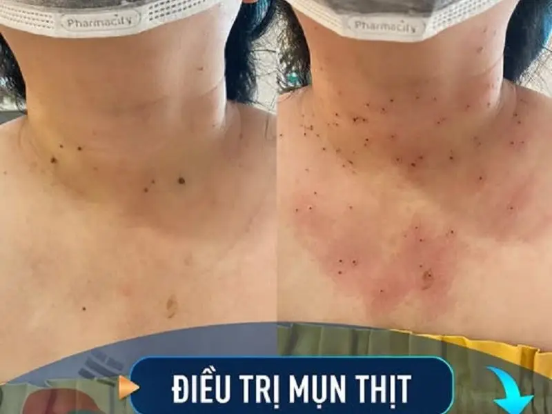 Điều trị mun thịt đúng cách sẽ giúp đạt hiệu quả tốt