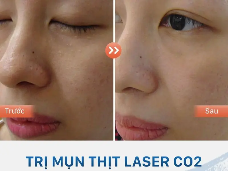 Khách hàng trị mụn thịt bằng Laser CO2 tại Kangnam