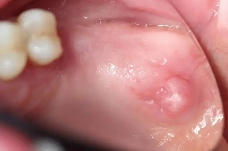 Nguyên nhân gây mụn thịt do sưng nướu hoặc tắc tuyến nước bọt