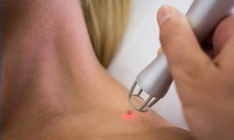 Sử dụng laser cũng là cách được bác sĩ áp dụng