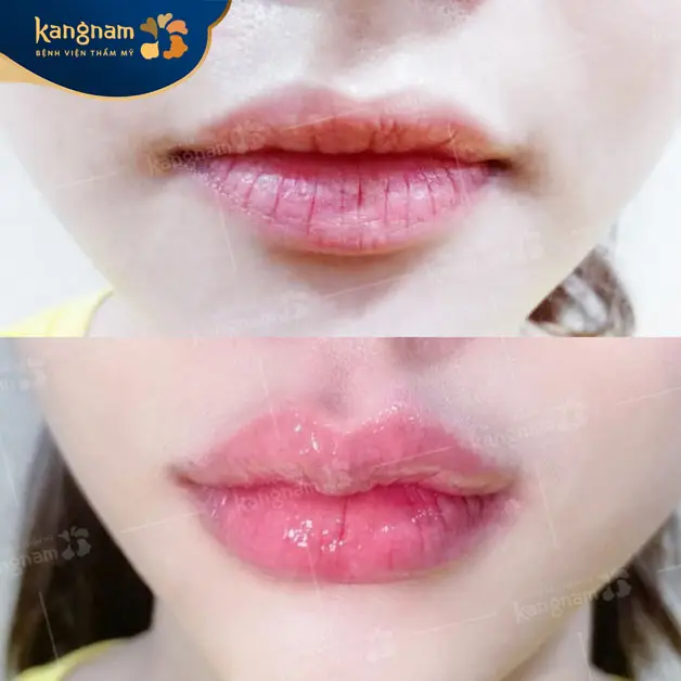 Môi trái tim giúp gương mặt thu hút hơn
