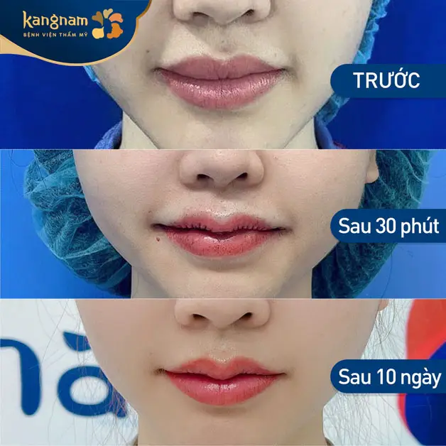 Cân đối lại dáng môi