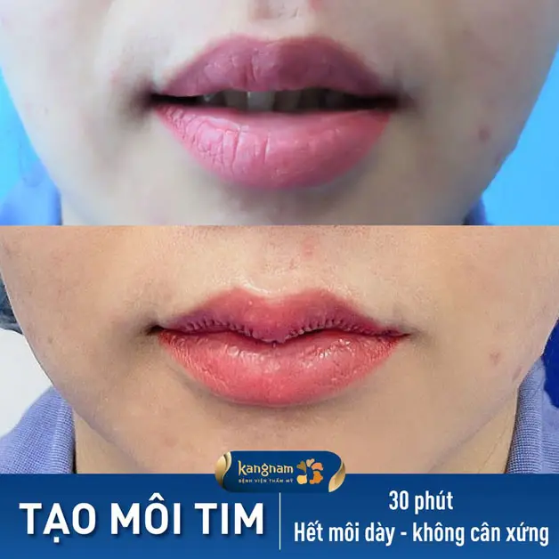 Phẫu thuật tạo hình môi trái tim