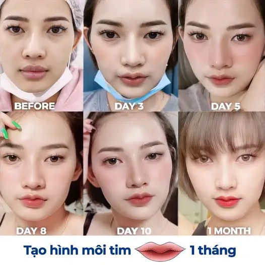Môi tim xinh sau 7 ngày