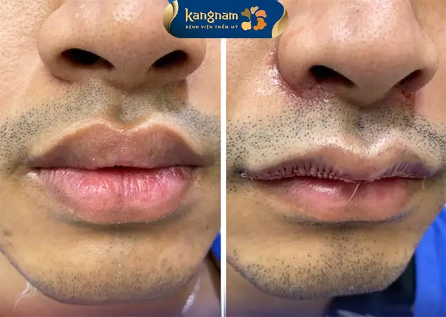 Khách hàng nam ngay sau khi tạo môi tim tạ Kangnam, tự nhiên, không sẹo
