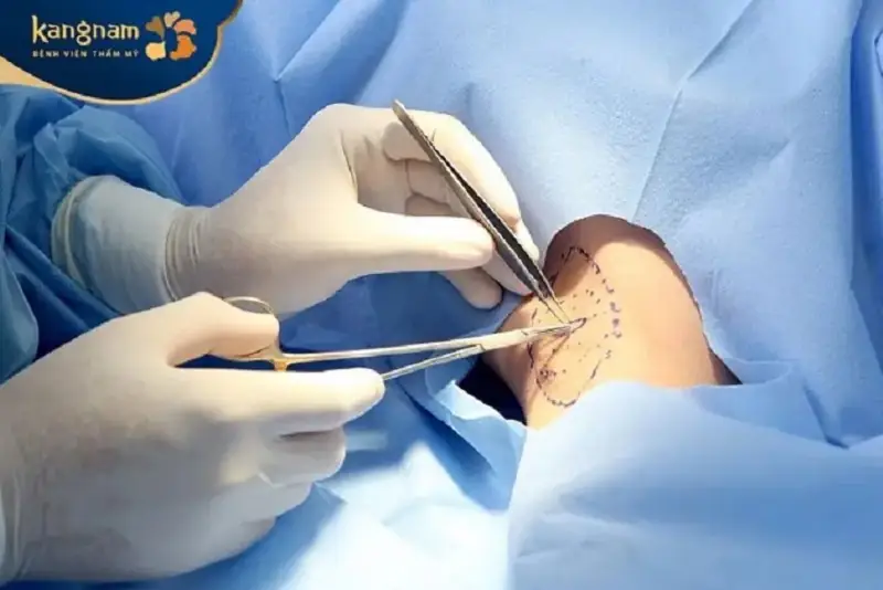 Cắt tuyến mồ hôi nách giúp ngăn ngừa hôi nách hiệu quả