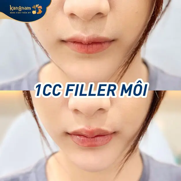 Khách hàng tiêm filler môi tại Kangnaam sở hữu môi tim căng mọng, tự nhiên