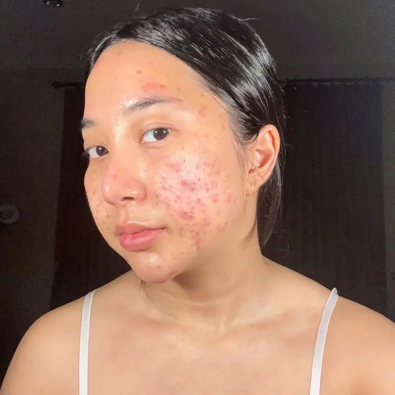Tình trạng thâm mụn nặng, da có mụn viêm và không đều màu