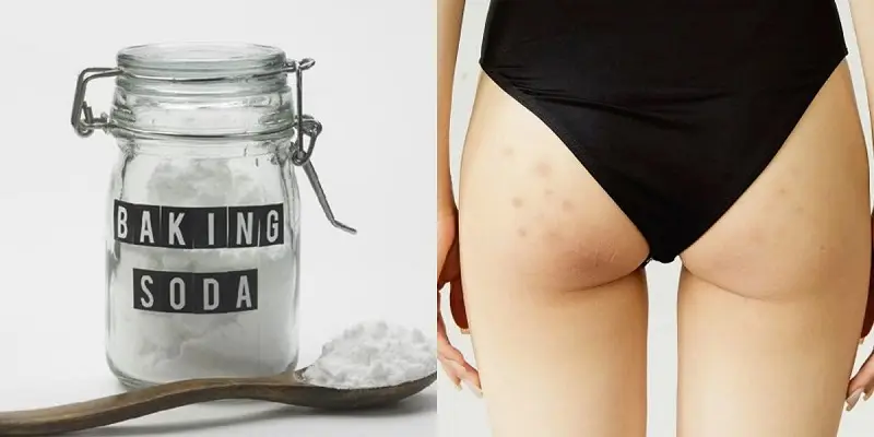baking soda trị thâm mông hiệu quả