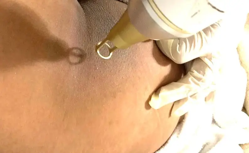 Tia laser với bước sóng phù hợp làm sáng da vùng mông